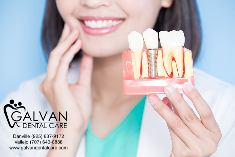 Galvan Dental Care | 480 Redwood St #30, Vallejo, CA 94590 | Phone: (707) 643-0888