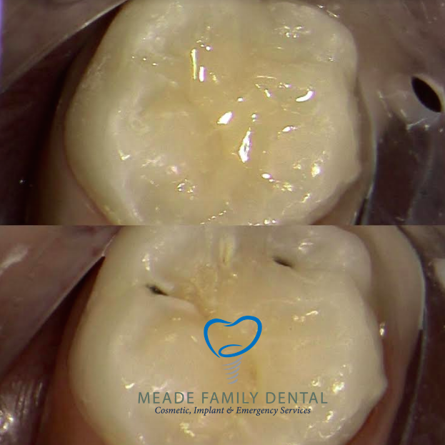 Meade Family Dental of Benicia | 1440 Military W UNIT 102, Benicia, CA 94510 | Phone: (707) 745-2121