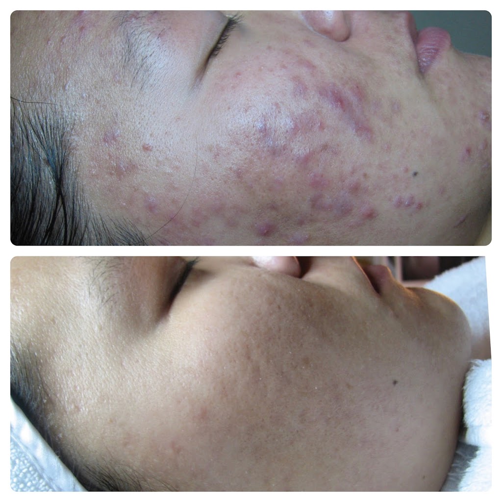 Balanced Skin and Acne Clinic | 585 Coombsville Rd, Napa, CA 94558 | Phone: (707) 227-7096