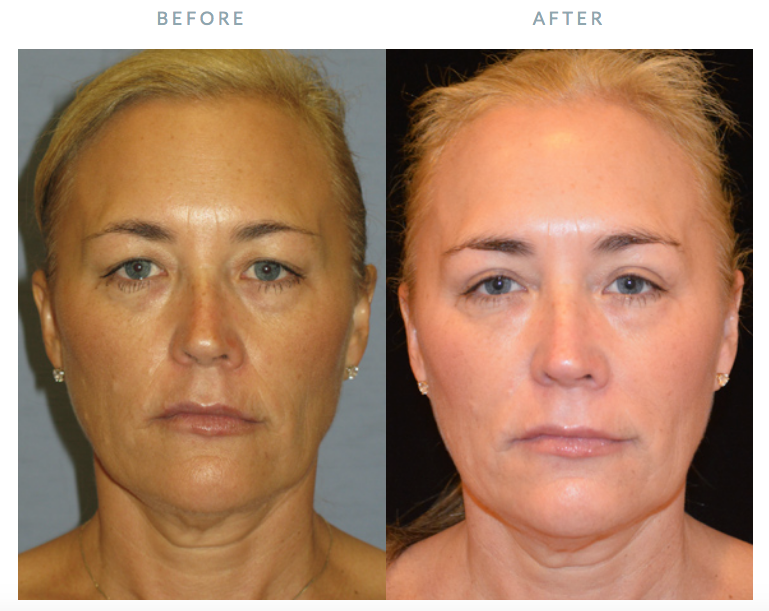 Plastic Surgery Specialists: Dr. Stanley G. Poulos | 350 Bon Air Rd #300, Greenbrae, CA 94904 | Phone: (415) 925-2880