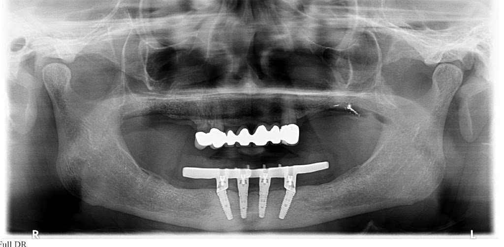 Dr Mogre Oral Facial Surgery & Dental Implants | 505 South Dr #4, Mountain View, CA 94040 | Phone: (650) 965-2222